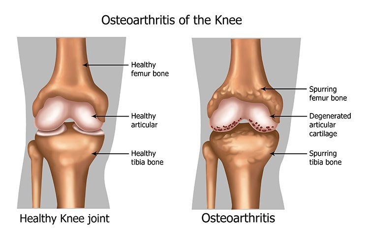 Osteoarthritis Pain Relief In Cleveland , OH - Cleveland Acupuncture Clinic