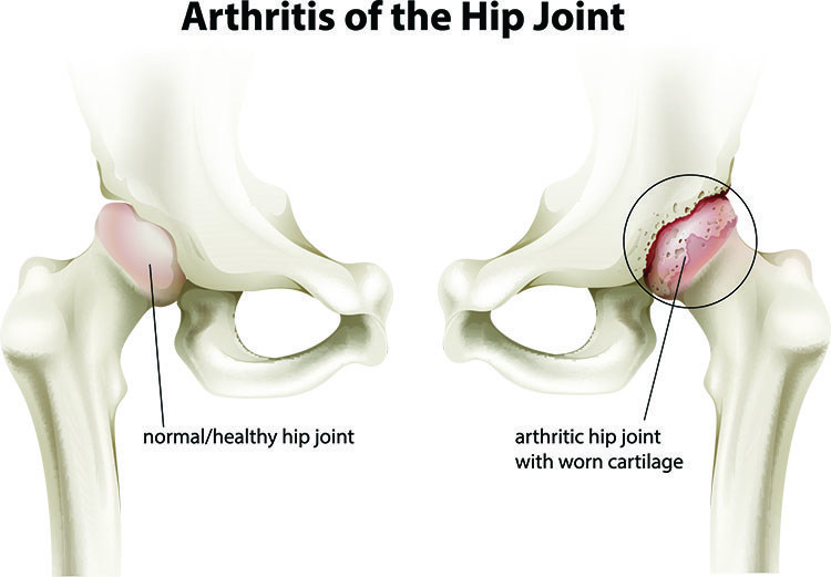 Arthritis Pain Relief In Cleveland , OH - Cleveland Acupuncture Clinic
