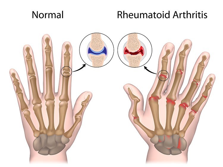 Rheumatoid Arthritis Pain Relief In Cleveland , OH - Cleveland Acupuncture Clinic